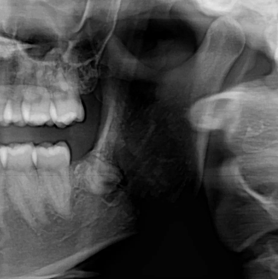 One year after Coronectomy