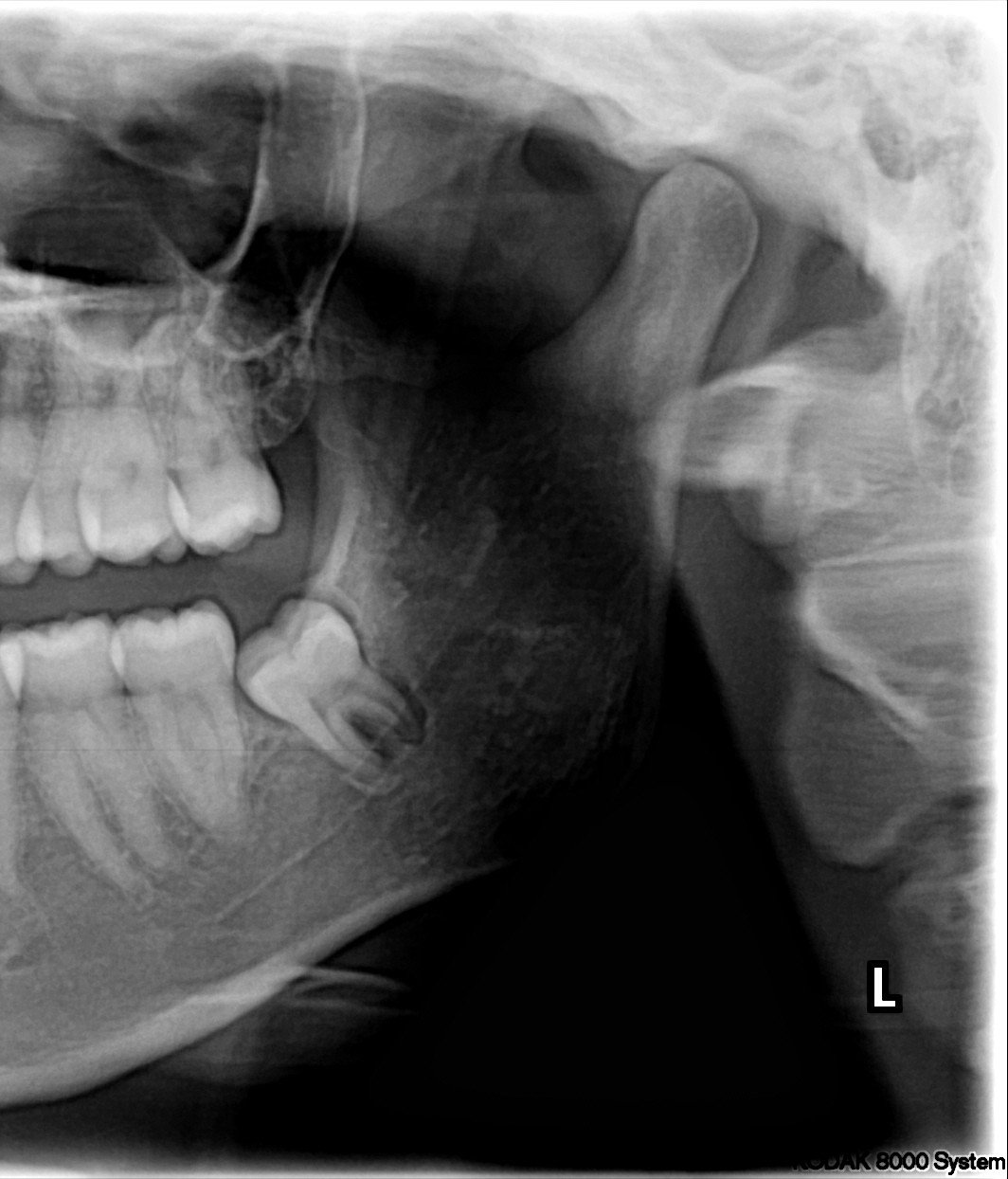 Before coronectomy