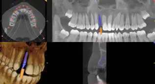 X-ray illustations demonstrating Teeth in a day.