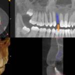 X-ray illustations demonstrating Teeth in a day.