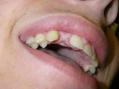 Missing tooth