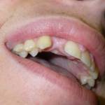 Missing tooth