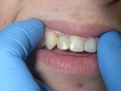 teeth in a day