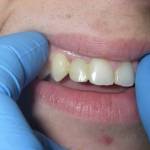 teeth in a day