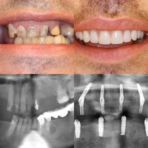 Before and after teeth-in-a-single-day