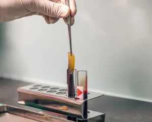 an oral surgeon removes platelet rich fibrin from a test tube.