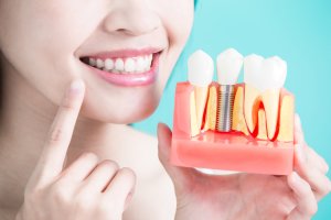 A woman holds a guided dental implants diagram and points to her mouth.